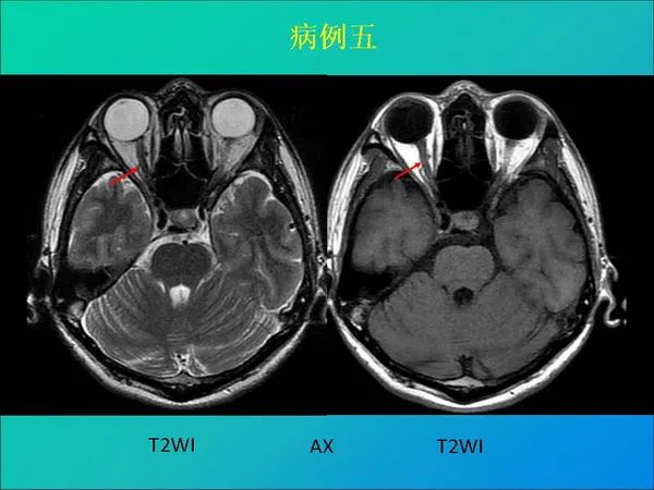 【PPT】常见眶内肿瘤影像诊断与鉴别诊断