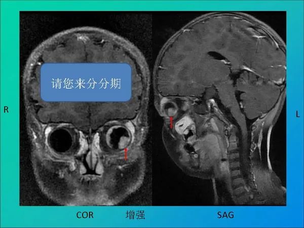 【PPT】常见眶内肿瘤影像诊断与鉴别诊断