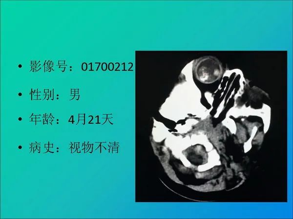 【PPT】常见眶内肿瘤影像诊断与鉴别诊断