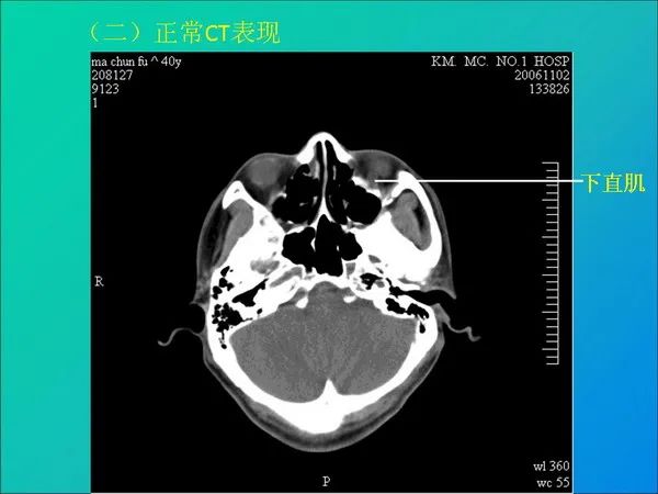 【PPT】常见眶内肿瘤影像诊断与鉴别诊断