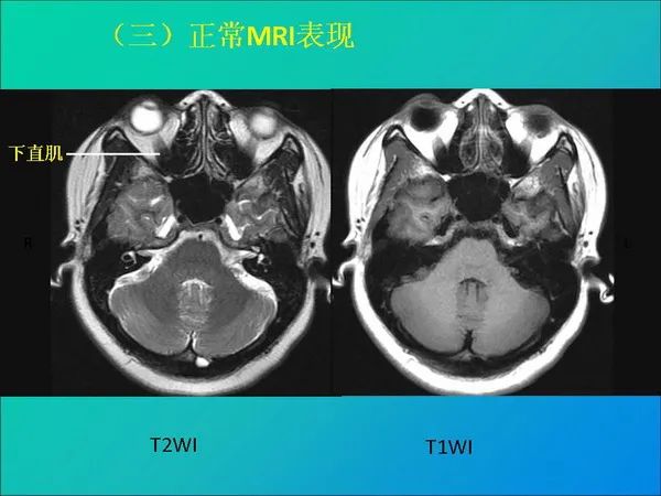 【PPT】常见眶内肿瘤影像诊断与鉴别诊断
