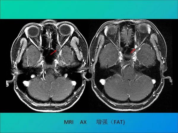 【PPT】常见眶内肿瘤影像诊断与鉴别诊断