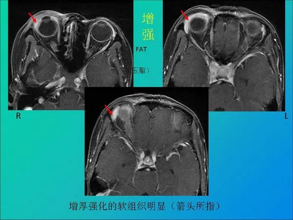 【PPT】常见眶内肿瘤影像诊断与鉴别诊断