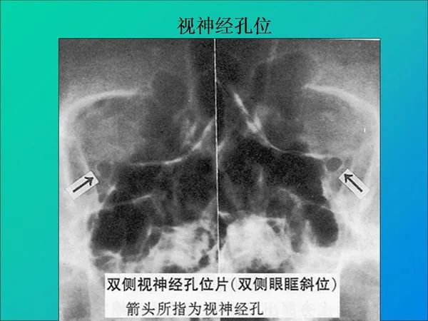 【PPT】常见眶内肿瘤影像诊断与鉴别诊断