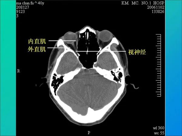 【PPT】常见眶内肿瘤影像诊断与鉴别诊断