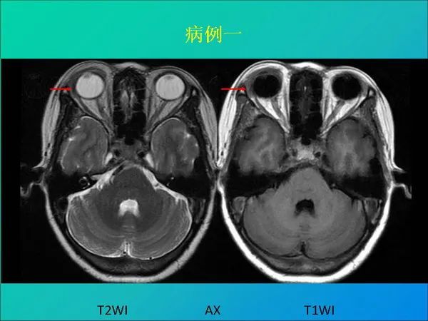 【PPT】常见眶内肿瘤影像诊断与鉴别诊断
