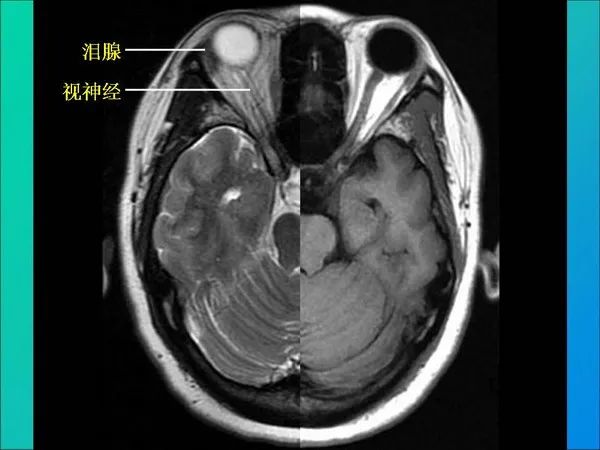 【PPT】常见眶内肿瘤影像诊断与鉴别诊断
