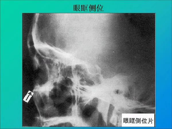【PPT】常见眶内肿瘤影像诊断与鉴别诊断