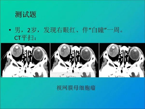 【PPT】常见眶内肿瘤影像诊断与鉴别诊断