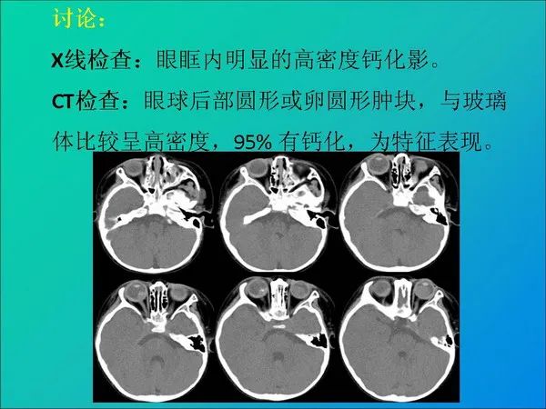 【PPT】常见眶内肿瘤影像诊断与鉴别诊断