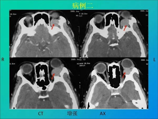【PPT】常见眶内肿瘤影像诊断与鉴别诊断