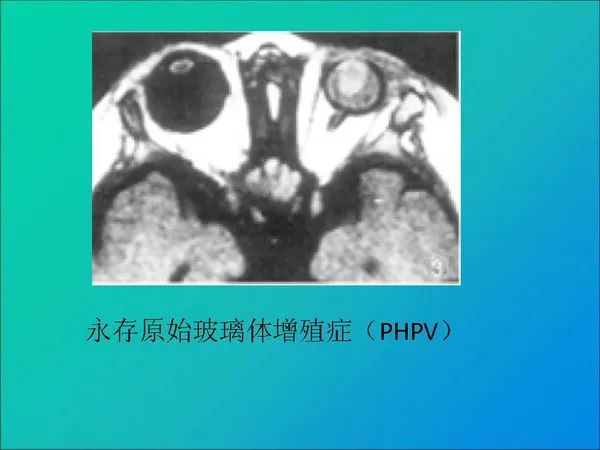 【PPT】常见眶内肿瘤影像诊断与鉴别诊断