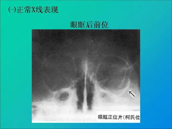 【PPT】常见眶内肿瘤影像诊断与鉴别诊断