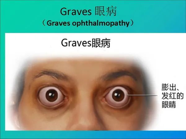 【PPT】常见眶内肿瘤影像诊断与鉴别诊断
