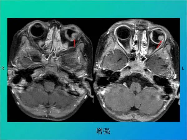【PPT】常见眶内肿瘤影像诊断与鉴别诊断