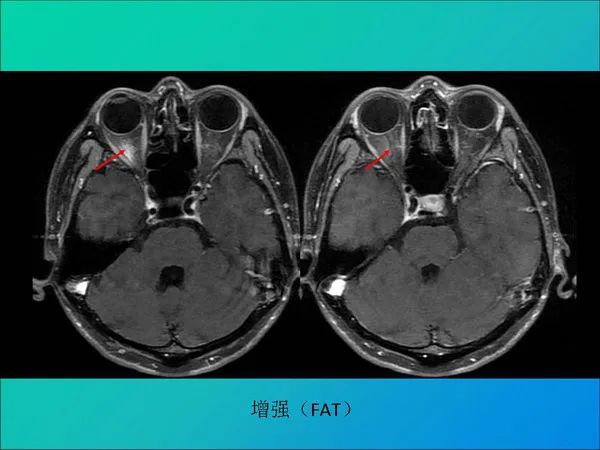 【PPT】常见眶内肿瘤影像诊断与鉴别诊断
