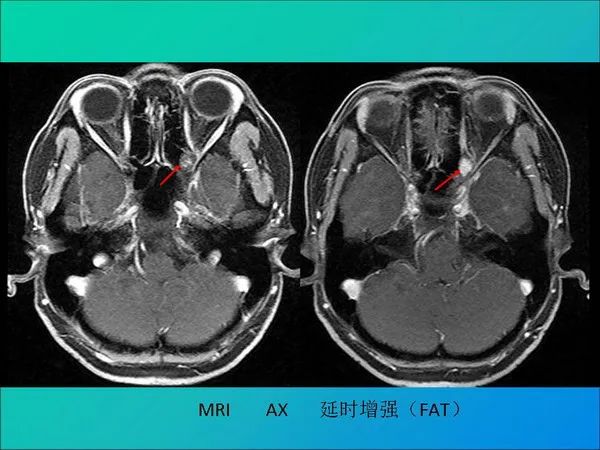 【PPT】常见眶内肿瘤影像诊断与鉴别诊断