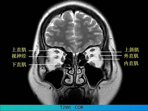 【PPT】常见眶内肿瘤影像诊断与鉴别诊断