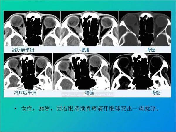 【PPT】常见眶内肿瘤影像诊断与鉴别诊断