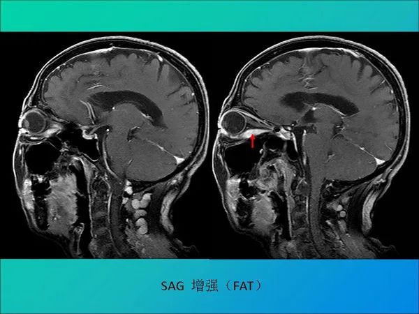 【PPT】常见眶内肿瘤影像诊断与鉴别诊断