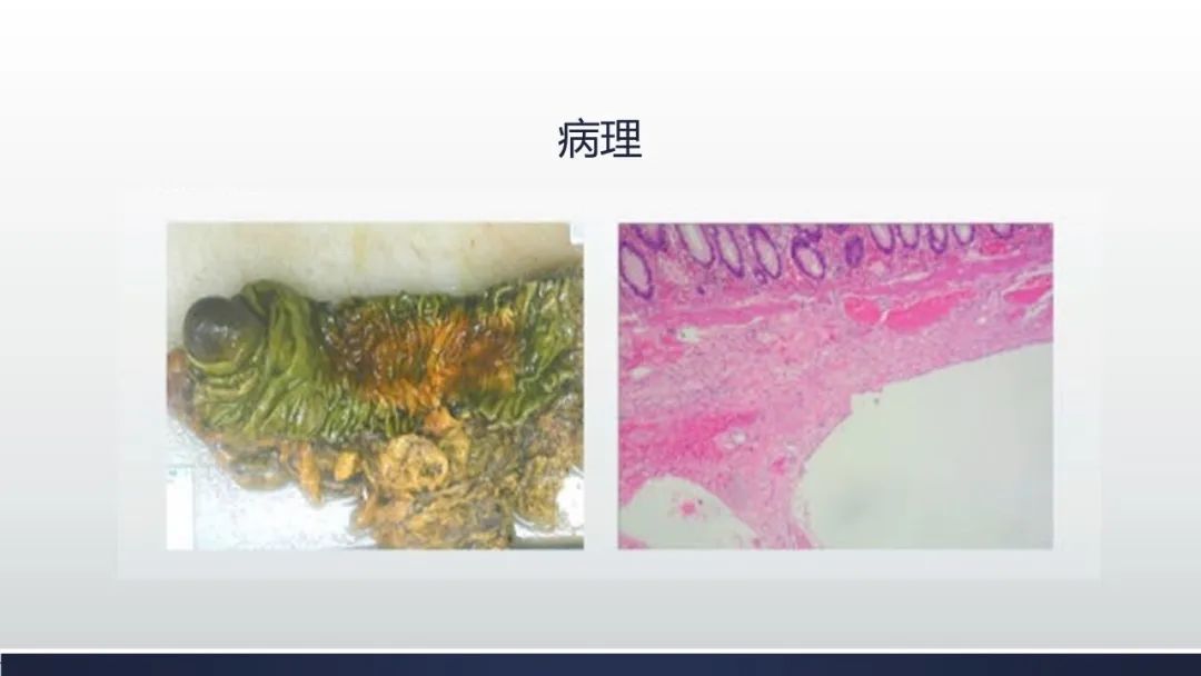 【病例】肠壁海绵状淋巴管瘤伴套叠1例CT