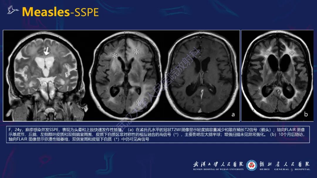 【PPT】新发和再发传染病神经影像学表现