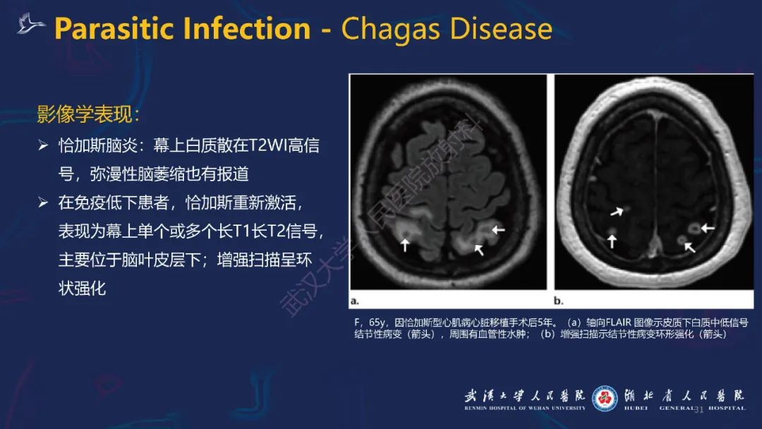 【PPT】新发和再发传染病神经影像学表现