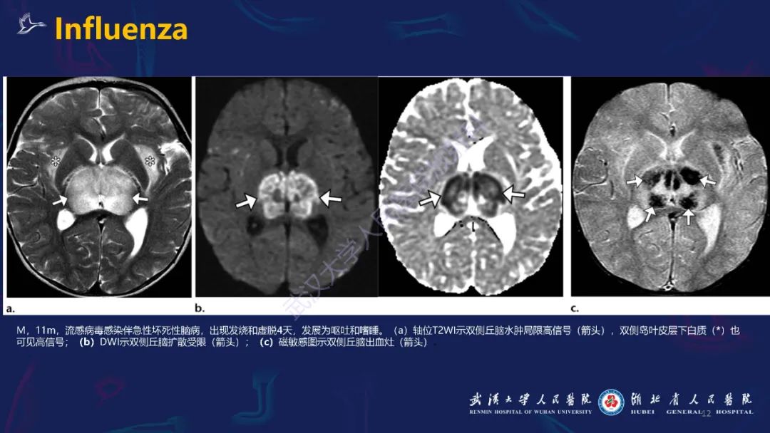 【PPT】新发和再发传染病神经影像学表现