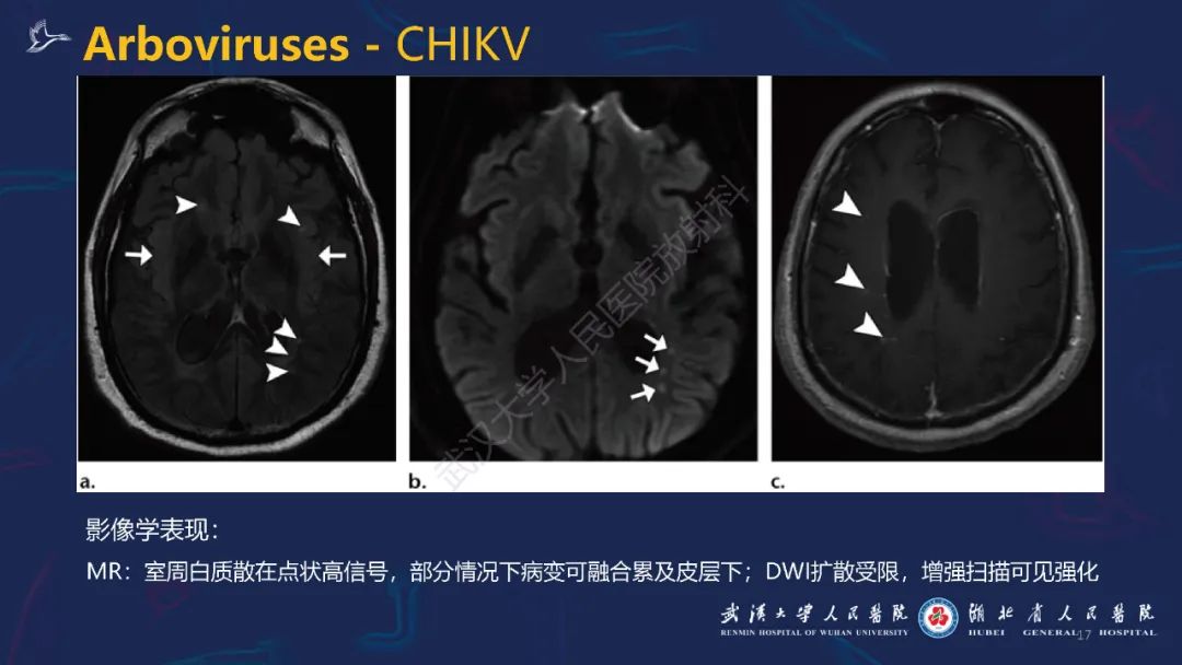 【PPT】新发和再发传染病神经影像学表现