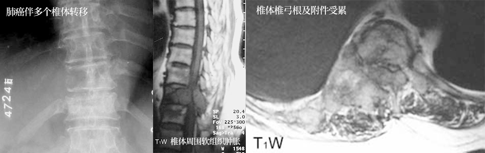 以囊性病灶为主的骨肿瘤及肿瘤样病变影像解析