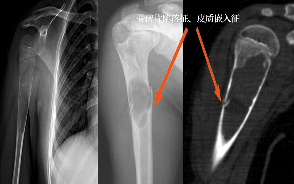 以囊性病灶为主的骨肿瘤及肿瘤样病变影像解析