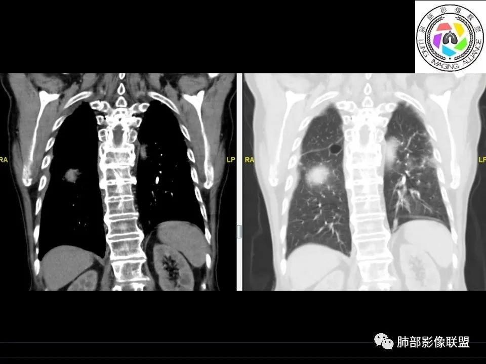 【病例】三明治征”之谜—胸膜淋巴瘤1例CT影像