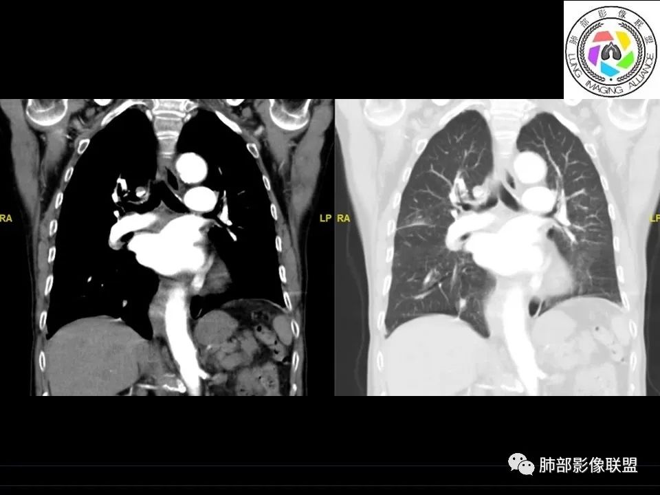 【病例】三明治征”之谜—胸膜淋巴瘤1例CT影像