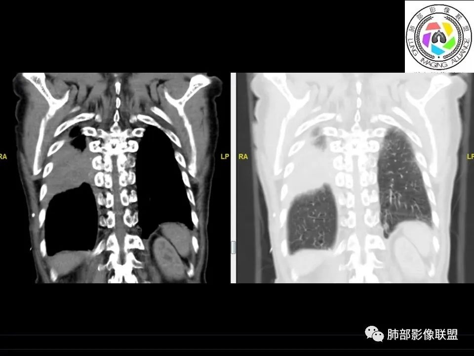 【病例】三明治征”之谜—胸膜淋巴瘤1例CT影像