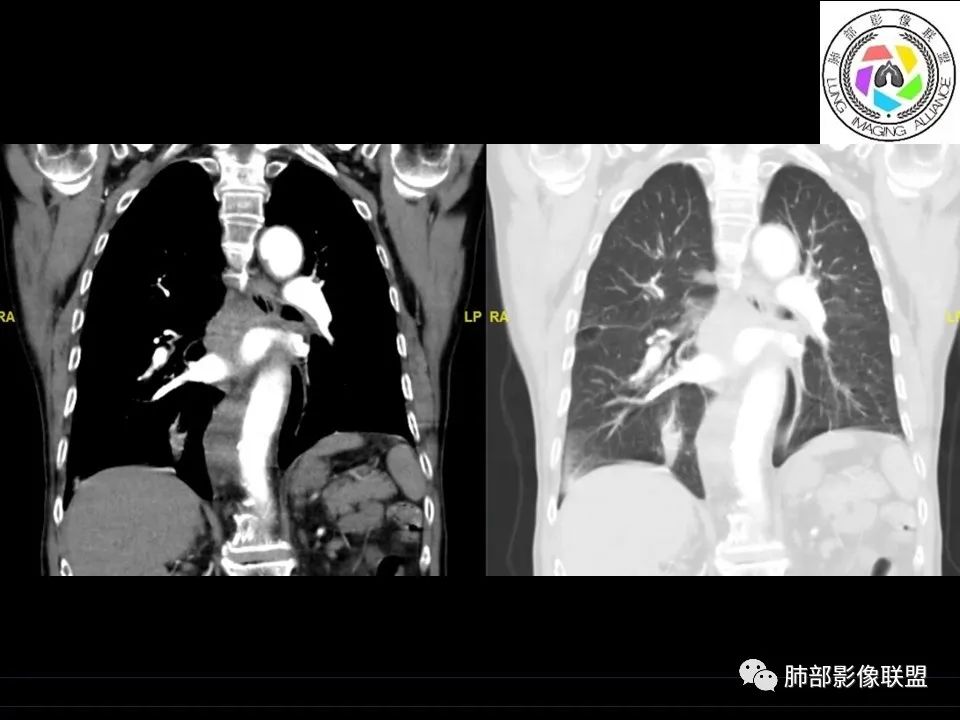 【病例】三明治征”之谜—胸膜淋巴瘤1例CT影像