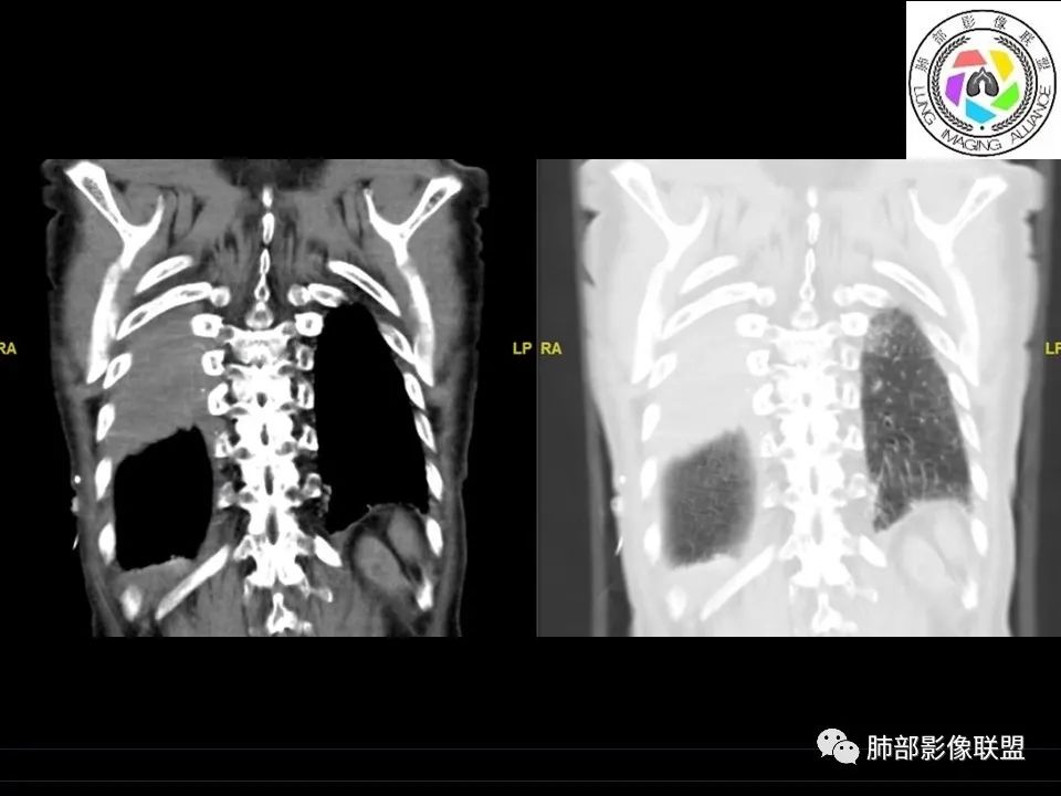 【病例】三明治征”之谜—胸膜淋巴瘤1例CT影像