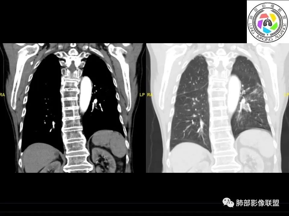 【病例】三明治征”之谜—胸膜淋巴瘤1例CT影像