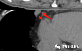 【病例】三明治征”之谜—胸膜淋巴瘤1例CT影像