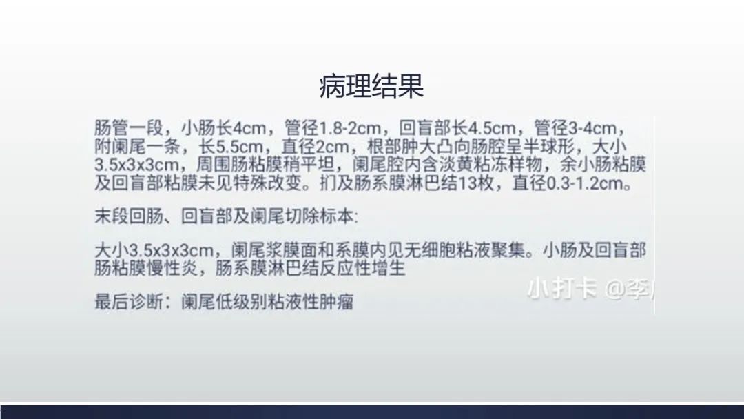 【病例】阑尾低级别粘液性肿瘤1例CT影像