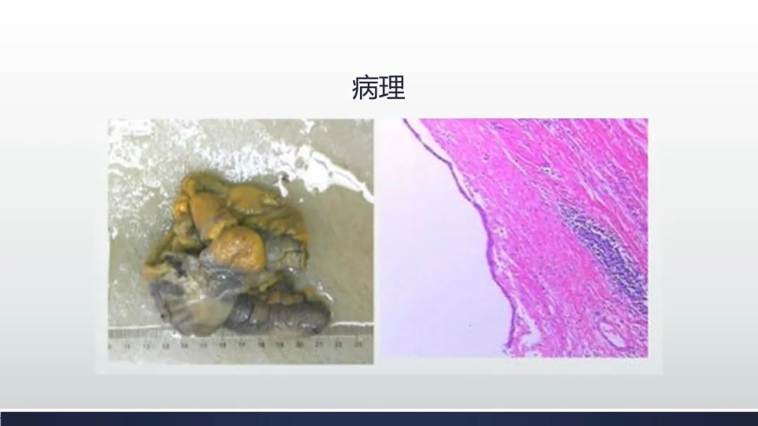 【病例】阑尾低级别粘液性肿瘤1例CT影像