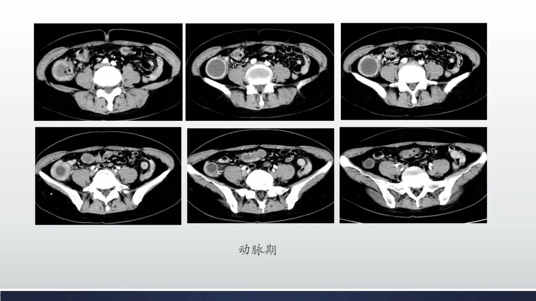【病例】阑尾低级别粘液性肿瘤1例CT影像