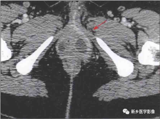 阴道前庭大腺炎
