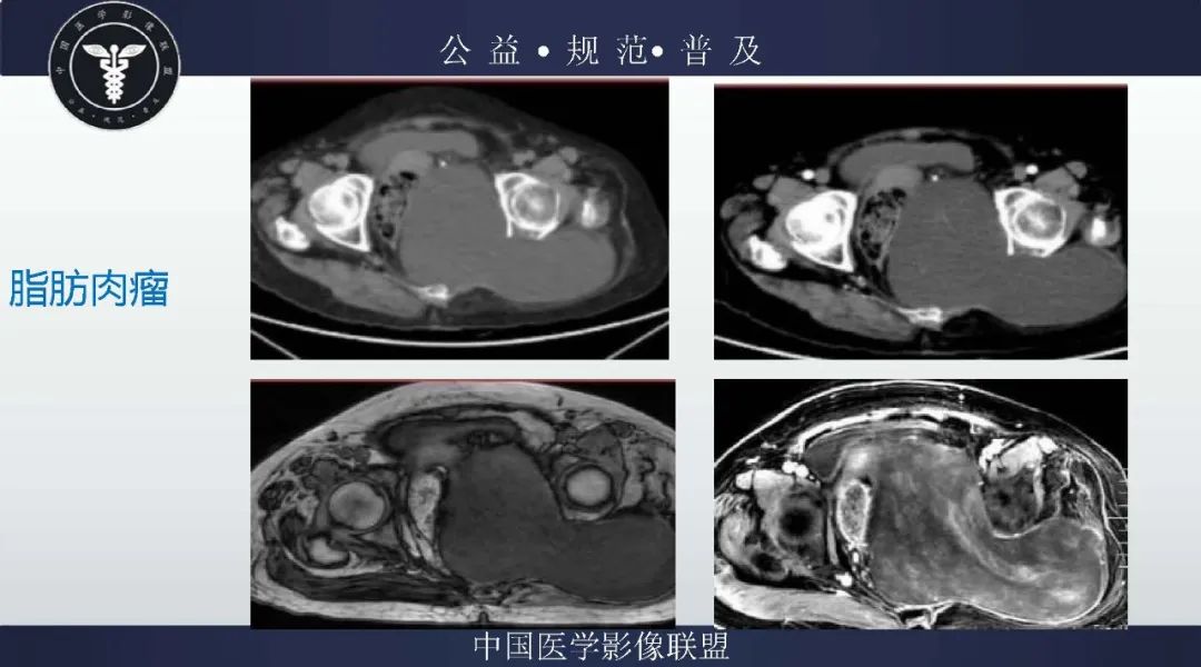 【病例】盆腔皮样囊肿1例MR影像