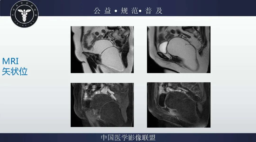 【病例】盆腔皮样囊肿1例MR影像