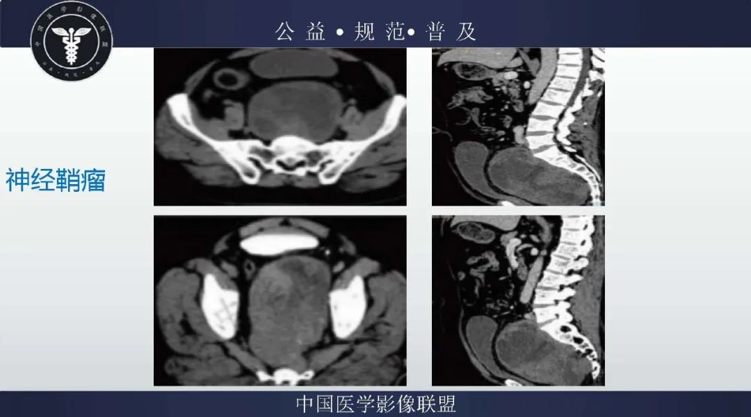 【病例】盆腔皮样囊肿1例MR影像
