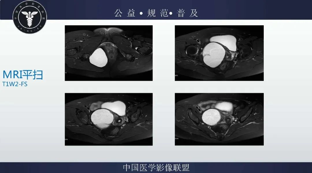 【病例】盆腔皮样囊肿1例MR影像