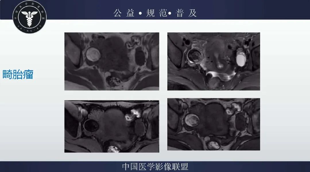 【病例】盆腔皮样囊肿1例MR影像