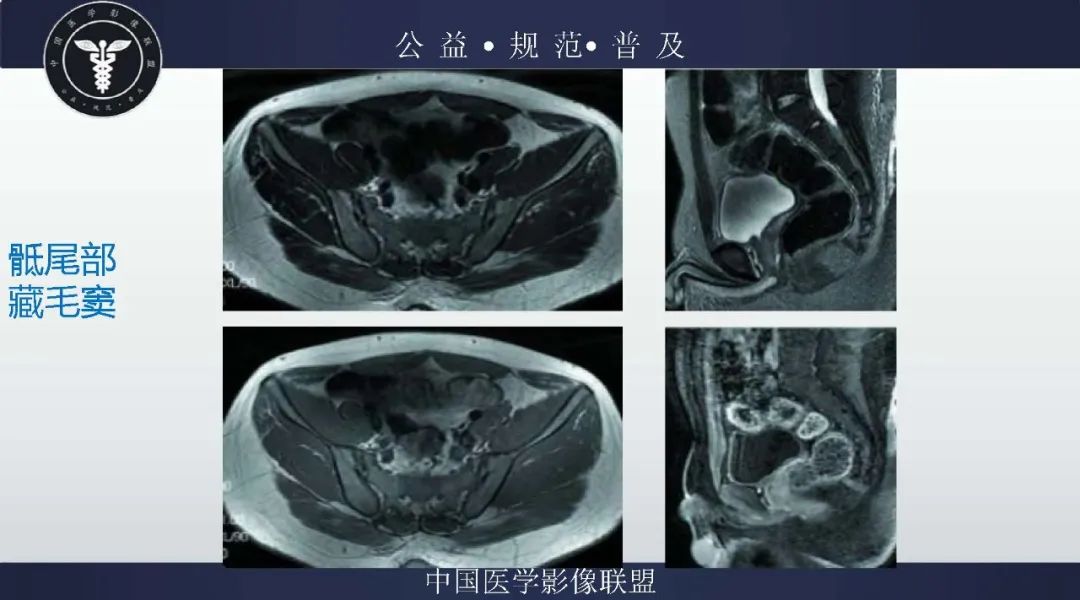 【病例】盆腔皮样囊肿1例MR影像