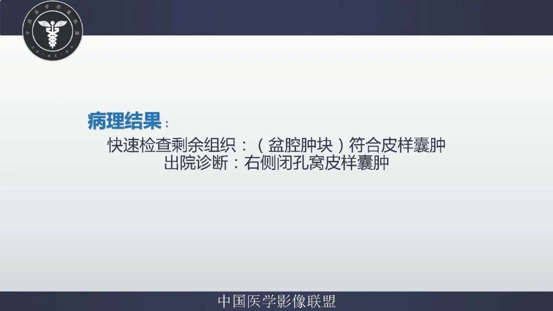 【病例】盆腔皮样囊肿1例MR影像