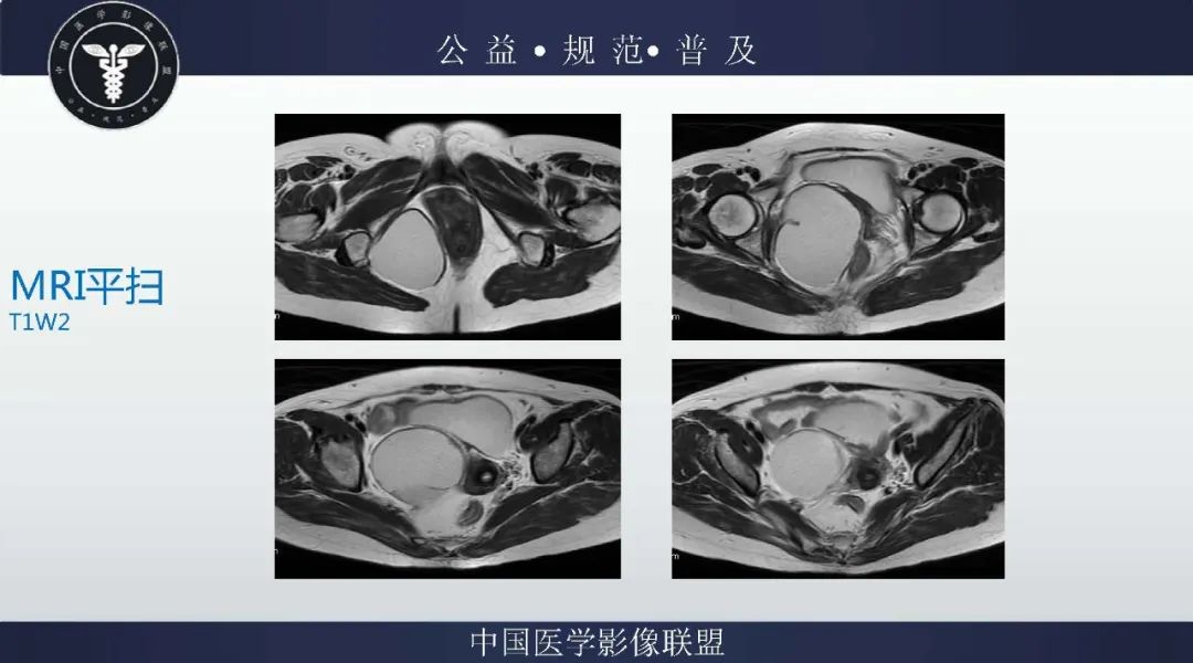 【病例】盆腔皮样囊肿1例MR影像